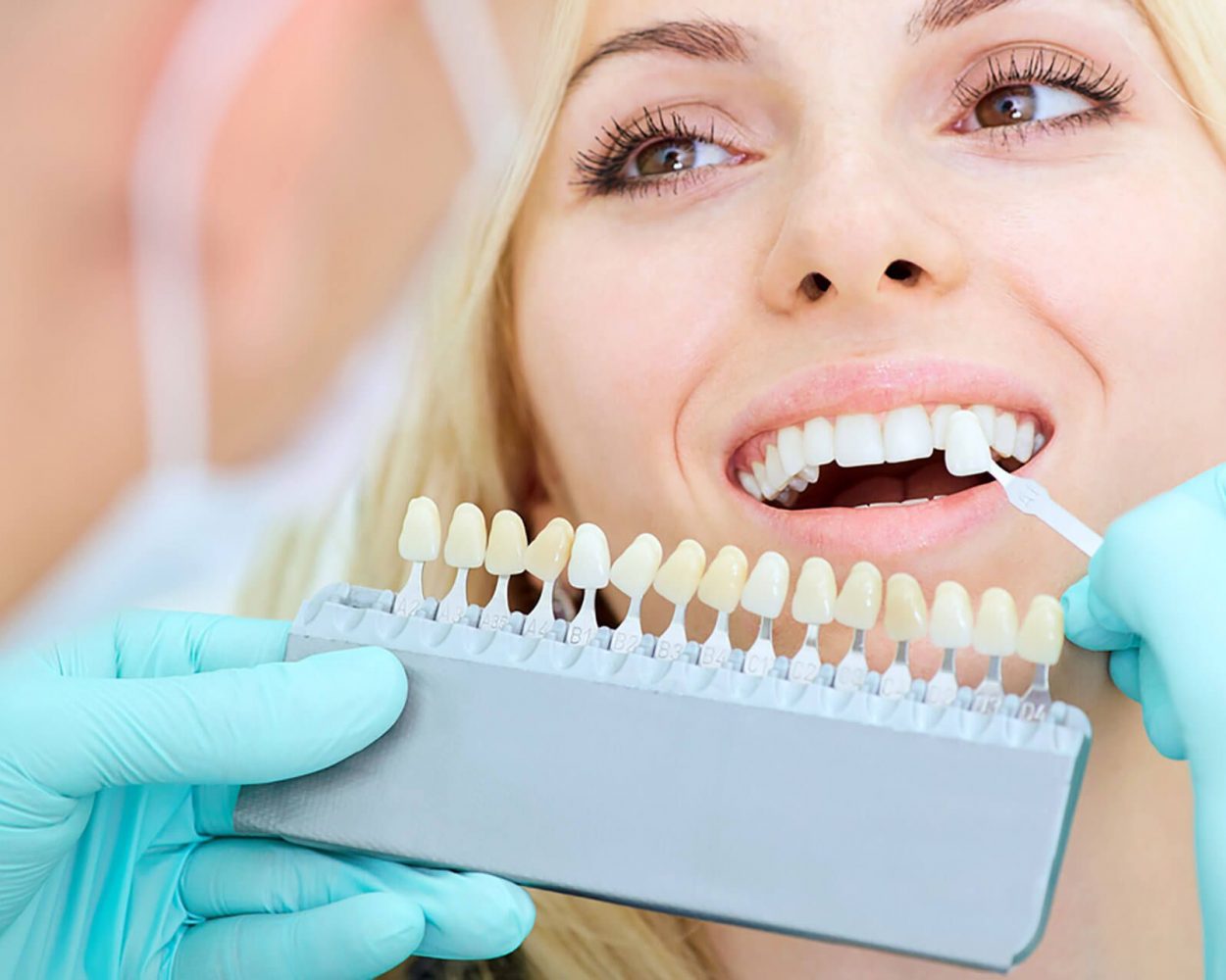 Selección del tono dental en un blanqueamiento en P&P Clinic Madrid