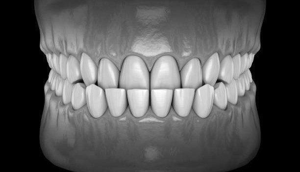 Puente dental de tres piezas