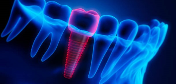 herramientas implantología dental 