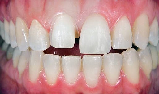 Invisalign full: el tratamiento efectivo que acaba con tu maloclusión dental