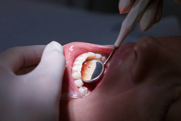 tratamientos para la periodontitis 