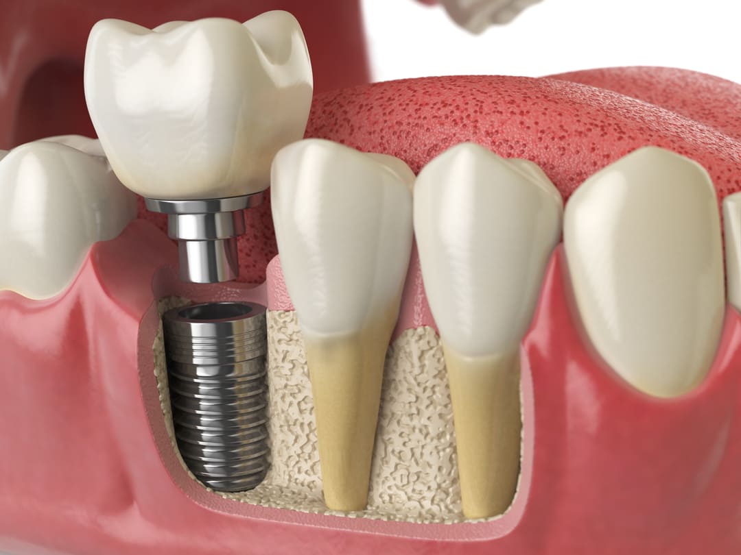 Estructura de un implante dental