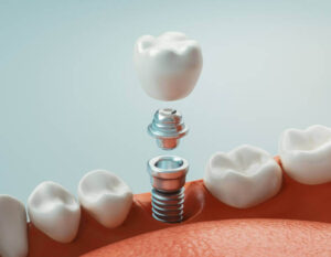 implantes dentales ventajas o inconvenientes