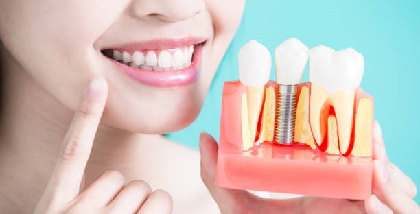implantes dentales sin hueso 