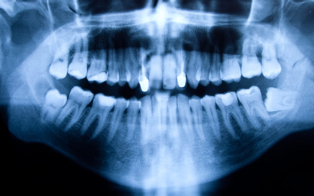 Descubre los mejores tratamientos de Agenesia dental
