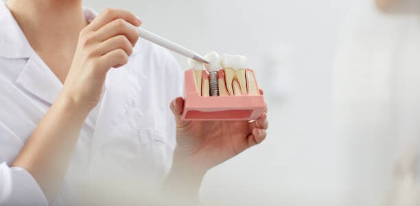 ¿Qué es un implante dental de carga inmediata ?