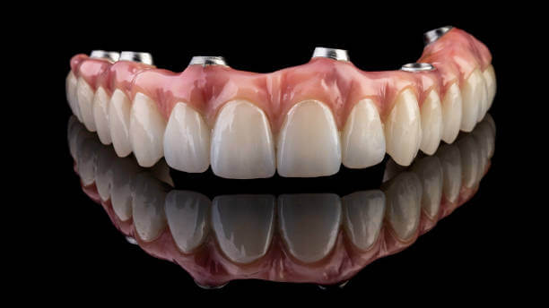 Tipos de de implantes dentales 