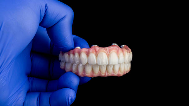 implantes dentales en Madrid