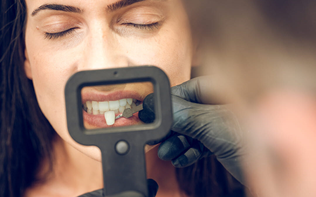 Carillas dentales: mejora tu sonrisa de forma rápida y sencilla