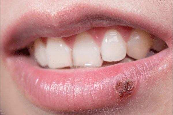 Calenturas labiales causas