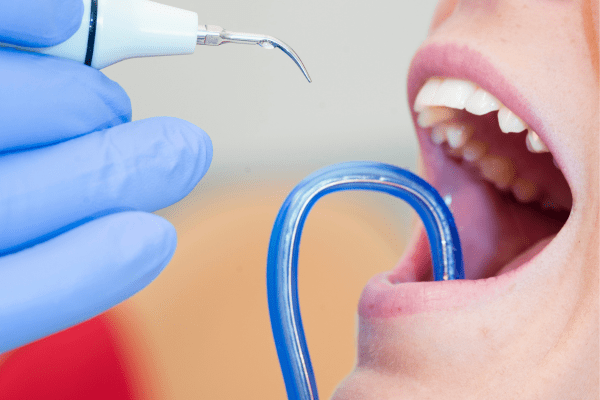El sarro duro detrás de los dientes: cómo evitarlo