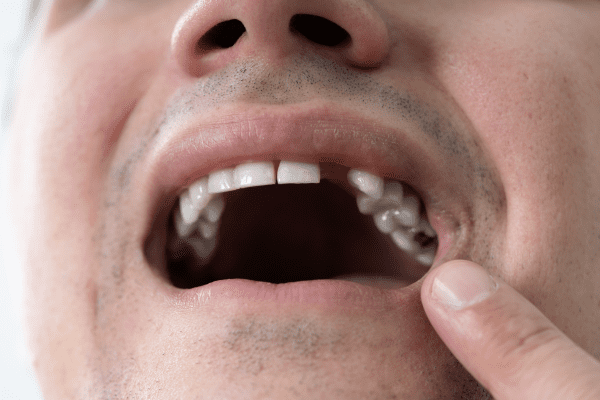 Consecuencias de estar sin dientes