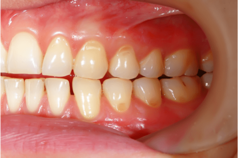 Dientes picados: consecuencias y tratamiento - P&P Clinic