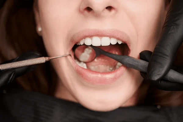 Abrasión dental qué es