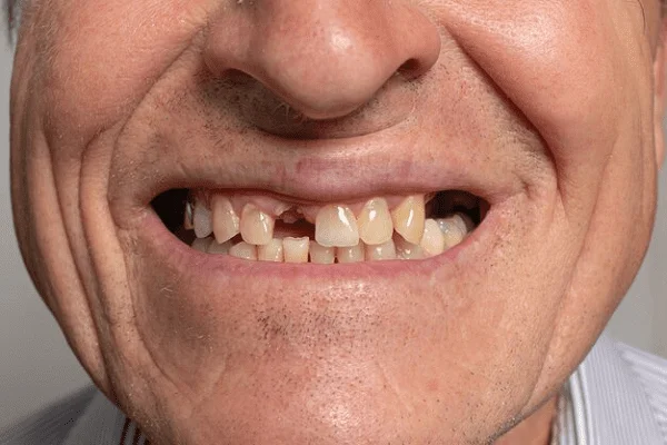 Causas del desgaste en el cuello de los dientes