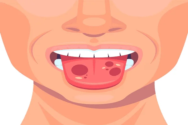 Cómo curar y aliviar las quemaduras en la lengua