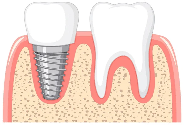 Taurodontismo dental qué es y consecuencias dentales