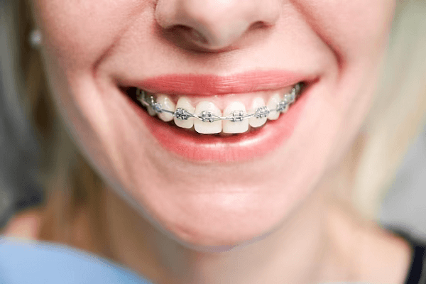 Brackets tradicionales