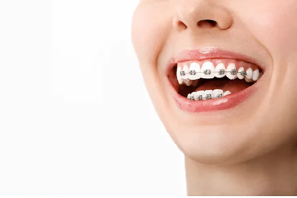 Uso de brackets metálicos
