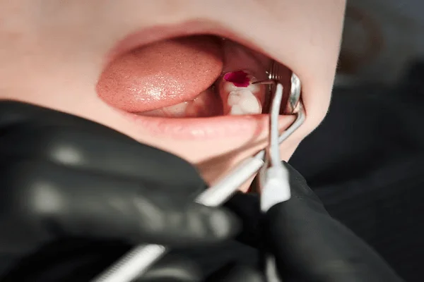 Tratamiento de caries profunda