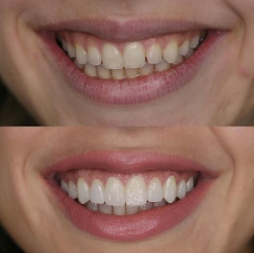 Carillas dentales antes y despues 2