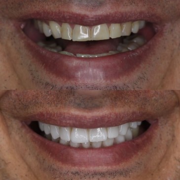 Carillas dentales antes y despues 3