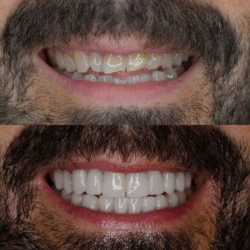 Carillas dentales antes y despues 4