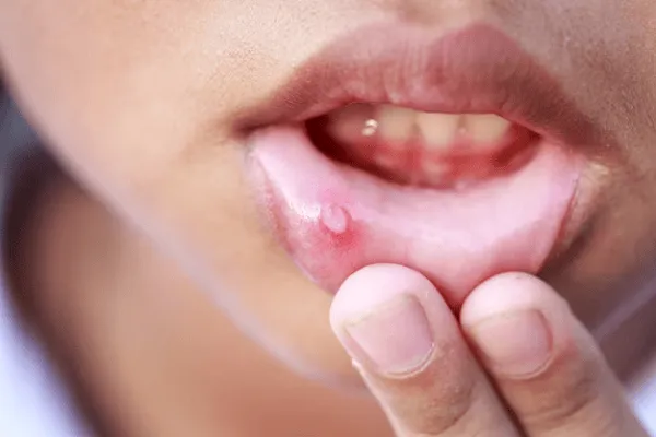 ¿Cómo curar llagas en la boca y encías?