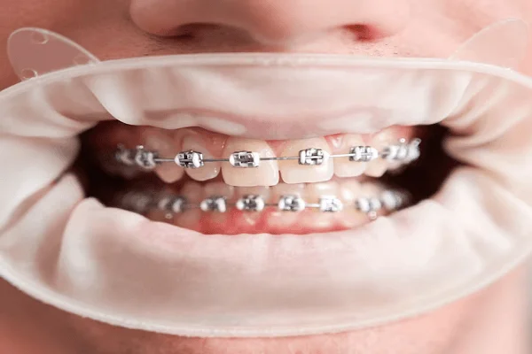 Invisaling y brackets