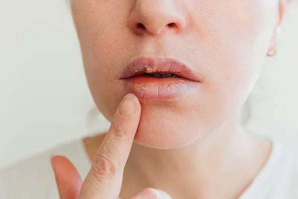 Razones para las manchas blancas en la boca