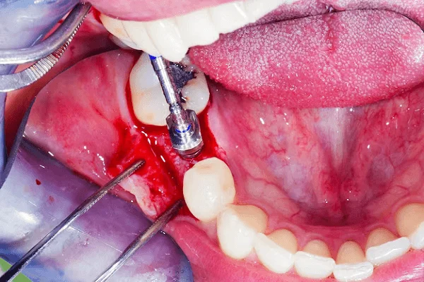 Regeneración de piezas dentales
