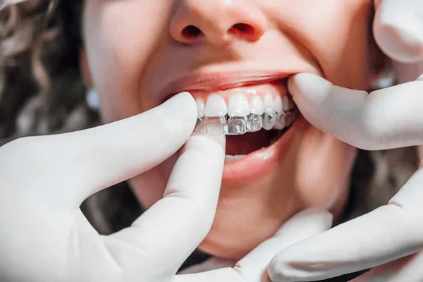 Aparatos dentales removibles