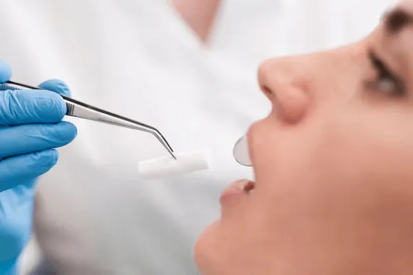 Todo Sobre la Gingivectomía Estética Lo que Necesitas Saber