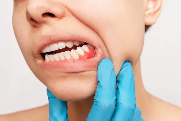 Todo Sobre la Gingivectomía Estética Lo que Necesitas Saber