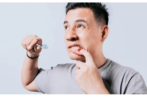 Qué es la sonrisa gingival y cómo tratarlo