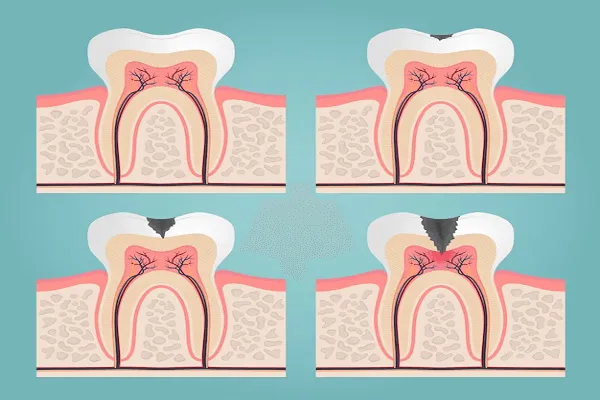 Rellenar hueco entre dientes con composite