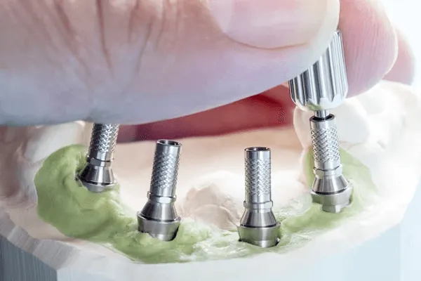 Recetas blandas para implantes dentales