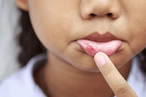 Todo sobre los granitos en la comisura de los labios