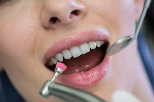Precios de Carillas Dentales y Estética Dental en España