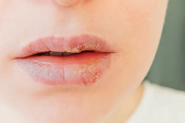 Todo sobre las ampollas labiales Causas y Tratamientos
