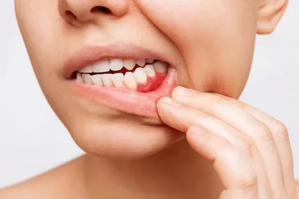 Todo sobre la Gingivitis Ulceronecrotizante y su Tratamiento