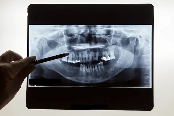 Todo sobre la radiografía panorámica dental