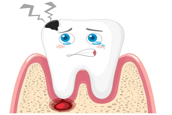Qué son las Caries en el Esmalte