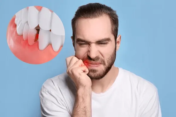 Qué son las Caries en el Esmalte