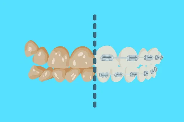 ¿Los Dientes Separados se pueden Juntar Solos?