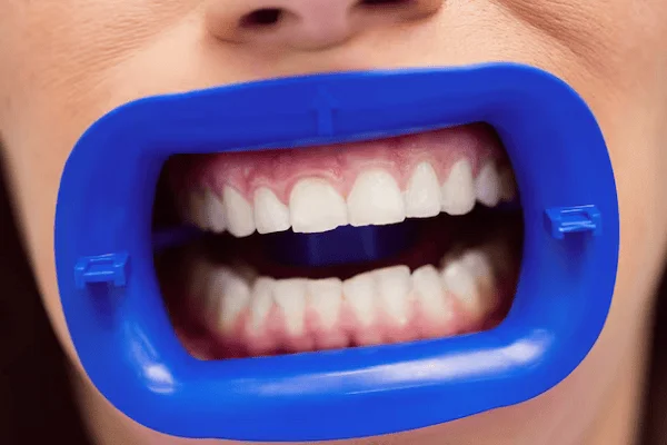 Decoloración de los dientes