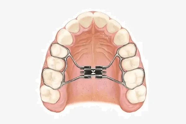 Descubre la importancia del disyuntor de paladar en la ortodoncia