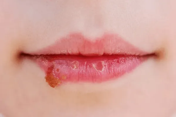 Descubrir las Ragades Labiales: Prevención y Cura
