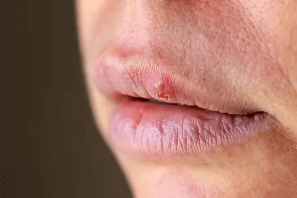 Descubrir las Ragades Labiales Prevención y Cura