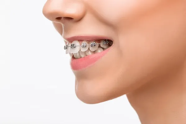 Alternativas para los Dientes Separados